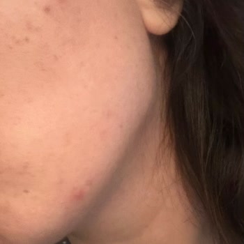 La Roche Posay Serum Beklenmedik Cilt Tepkileri Yarattı