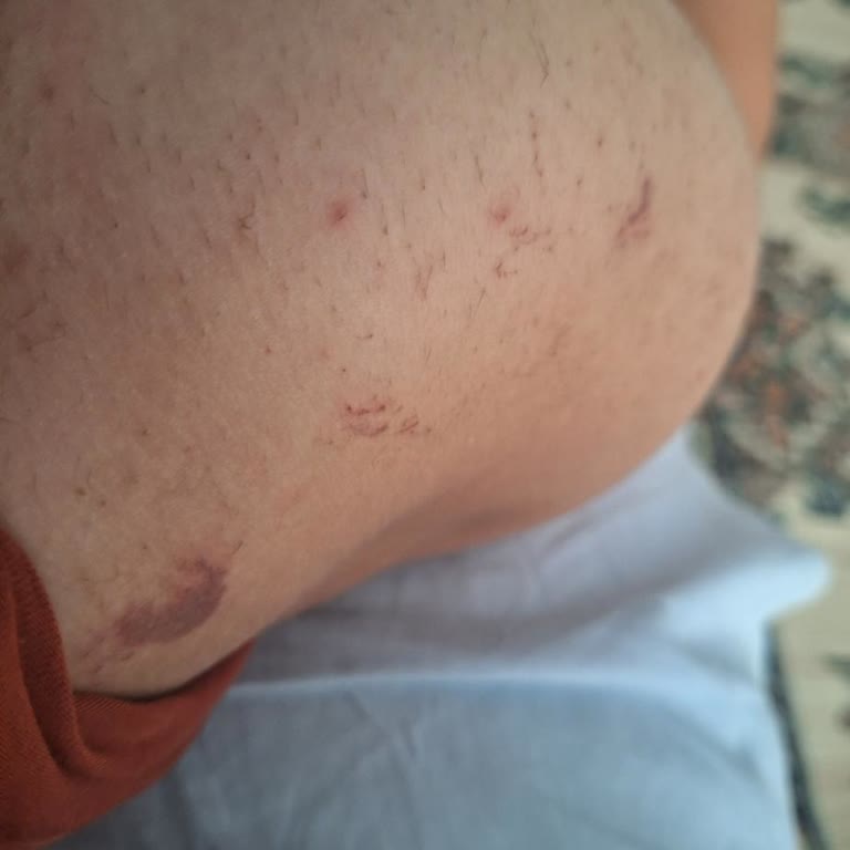 Hazal Babalık Beauty Lazer Epilasyon Sonrası Hayal Kırıklığı Ve Yanık İzleri