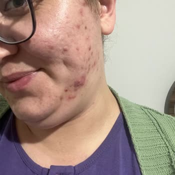 NT Kuaför Güzellik Merkezi Black Peeling Uyguladılar Yüzüm Mayın Tarlası Gibi Oldu