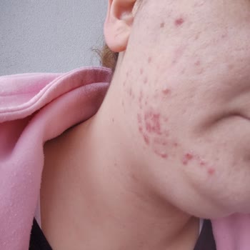 NT Kuaför Güzellik Merkezi Black Peeling Uyguladılar Yüzüm Mayın Tarlası Gibi Oldu