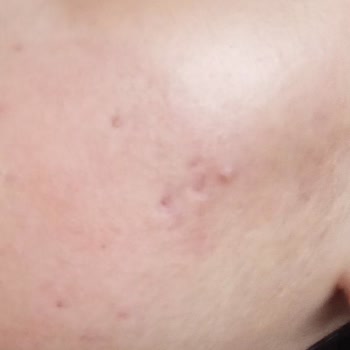 Devlet Hastanesinde Yetersiz Tedavi Ve Yan Etkilerle Boğuşma