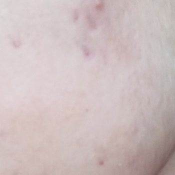 Devlet Hastanesinde Yetersiz Tedavi Ve Yan Etkilerle Boğuşma