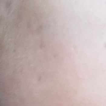 Devlet Hastanesinde Yetersiz Tedavi Ve Yan Etkilerle Boğuşma