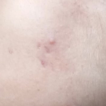 Devlet Hastanesinde Yetersiz Tedavi Ve Yan Etkilerle Boğuşma