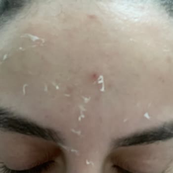 Yves Rocher Lift Pro-Collagene Serisi Ciltte Soyulma Sorunu