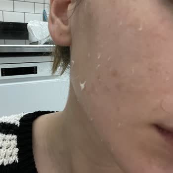 Yves Rocher Lift Pro-Collagene Serisi Ciltte Soyulma Sorunu