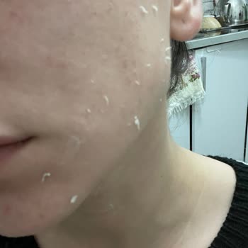 Yves Rocher Lift Pro-Collagene Serisi Ciltte Soyulma Sorunu