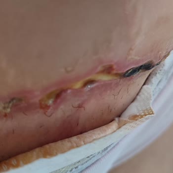 Ameliyat Sonrası Yaşanan Zorluklar Ve Hijyen Sorunları