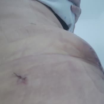 Ameliyat Sonrası Yaşanan Zorluklar Ve Hijyen Sorunları