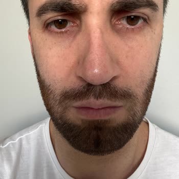 Başarısız Burun Ameliyatı Ve İletişim Sorunları