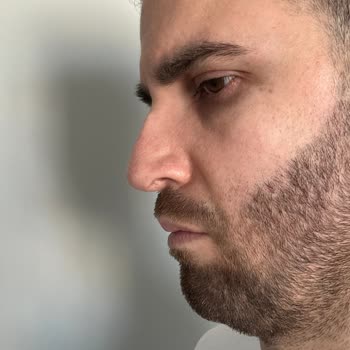 Başarısız Burun Ameliyatı Ve İletişim Sorunları