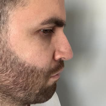 Başarısız Burun Ameliyatı Ve İletişim Sorunları