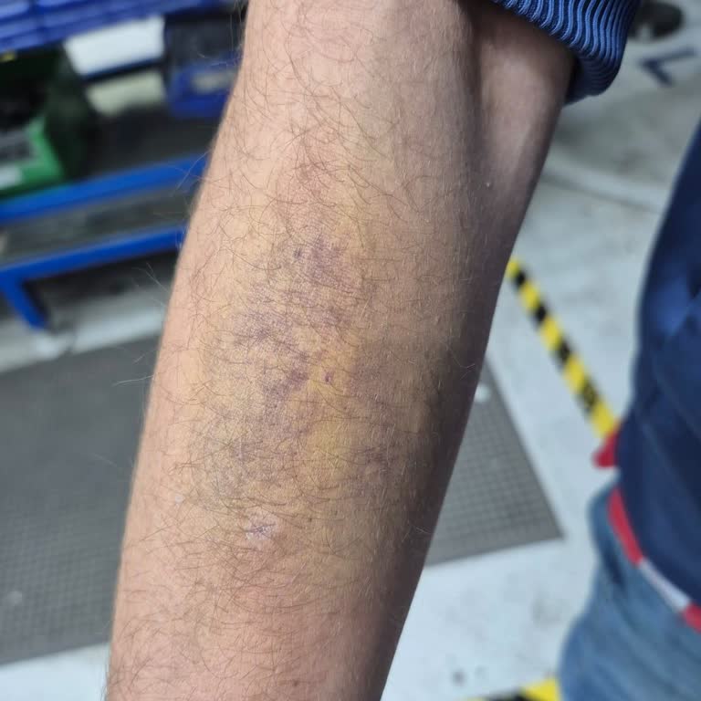 Acil Servisteki Serum Uygulaması Sonrası Kalıcı Ağrı Ve İz