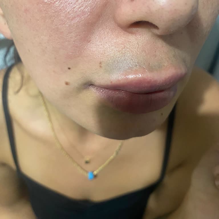 Yanlış Dolgu Ve Botoks Mağduriyeti