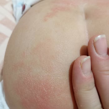 Goon Bebek Bezi Kullanımı Sonrası Cilt Sorunları!