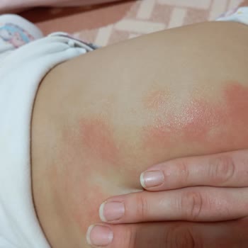 Goon Bebek Bezi Kullanımı Sonrası Cilt Sorunları!