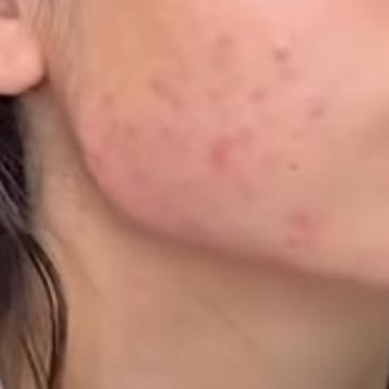 Kosmetolog_lalita Dolgu Hizmetinde Hayal Kırıklığı!