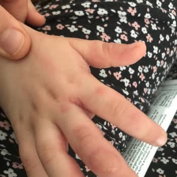 BİM'den Alınan Pasta Çocuğumda Alerjiye Sebep Oldu