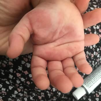 BİM'den Alınan Pasta Çocuğumda Alerjiye Sebep Oldu