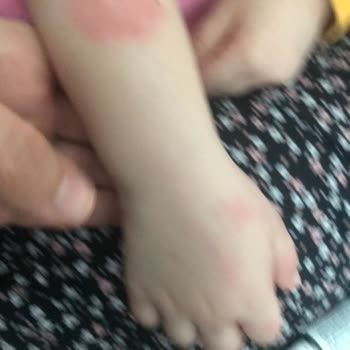 BİM'den Alınan Pasta Çocuğumda Alerjiye Sebep Oldu