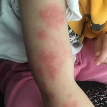 BİM'den Alınan Pasta Çocuğumda Alerjiye Sebep Oldu