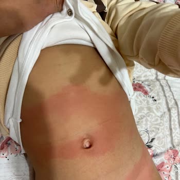 Bebeğimde Alerji Yapan Sleepy Bambu Bez