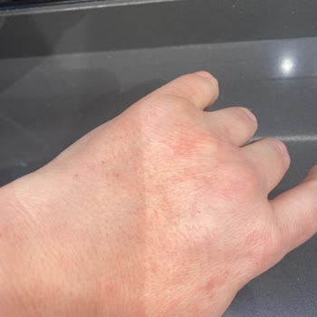 Bulaşık Deterjanı Ellerimde Tahrişe Sebep Oldu