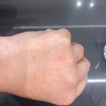 Bulaşık Deterjanı Ellerimde Tahrişe Sebep Oldu