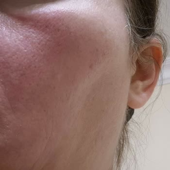 Bioderma Serum Kullanımında Ani Yanma Ve Kızarıklık