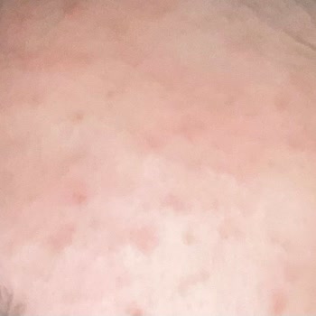 Pirinç Maskesi Kabusu: Ciltte Sivilce Ve Lekeler