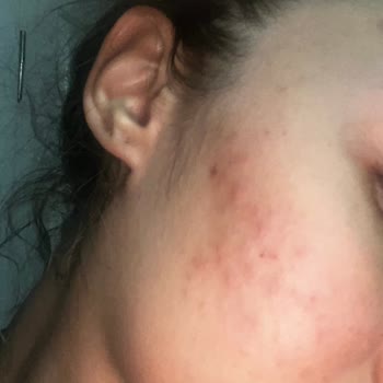 Pirinç Maskesi Kabusu: Ciltte Sivilce Ve Lekeler