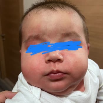 Bebeğimize Alerji Yapan Mama Kabusu