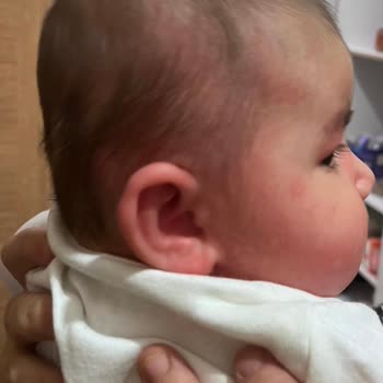 Bebeğimize Alerji Yapan Mama Kabusu