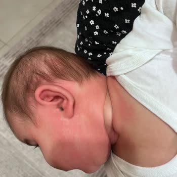 Bebeğimize Alerji Yapan Mama Kabusu