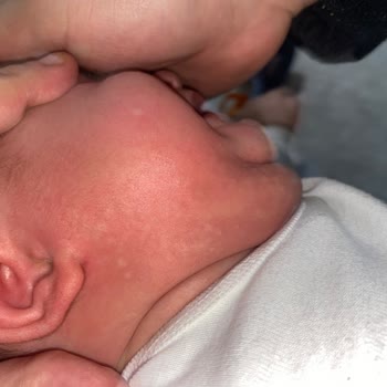 Bebeğimize Alerji Yapan Mama Kabusu