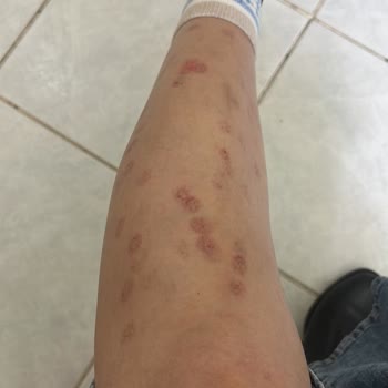 Lazer Epilasyon Sonrası Yanık Ve Yetersiz Destek