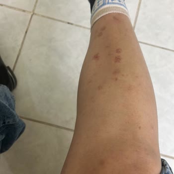 Lazer Epilasyon Sonrası Yanık Ve Yetersiz Destek