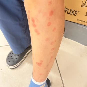 Lazer Epilasyon Sonrası Yanık Ve Yetersiz Destek