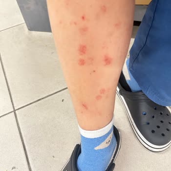 Lazer Epilasyon Sonrası Yanık Ve Yetersiz Destek