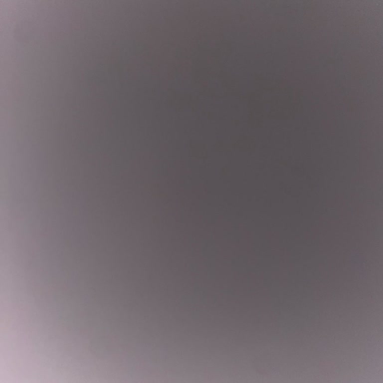 Lazer Epilasyon İadesinde Zorluklar