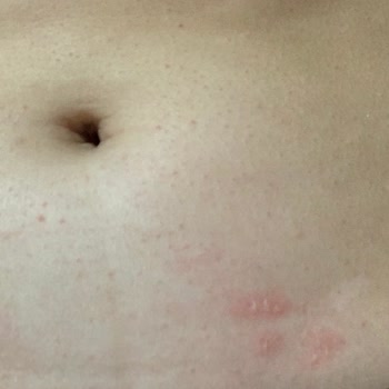 Isı Bandı Yanığı Ve İlgisiz Müşteri Hizmeti