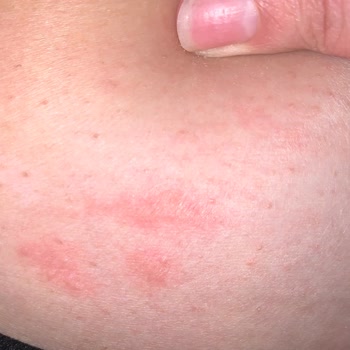 Isı Bandı Yanığı Ve İlgisiz Müşteri Hizmeti