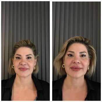 Estetik Kliniğinde Hayal Kırıklığı Ve İletişim Sorunları