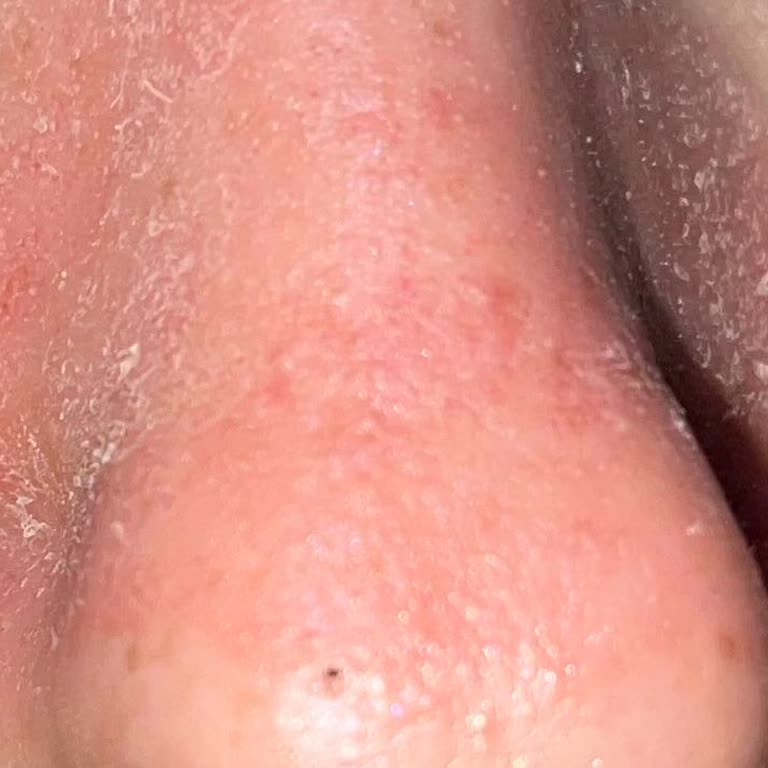 Bee Beauty Burun Bandı Cildimi Yaktı: Sağlık Tehlikesi!