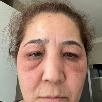 Loreal Retinol Gece Kremi Cildimi Mahvetti