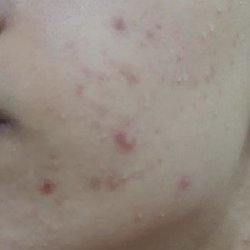 Laroche Posay Ürünleri Sivilcelerimi Artırdı
