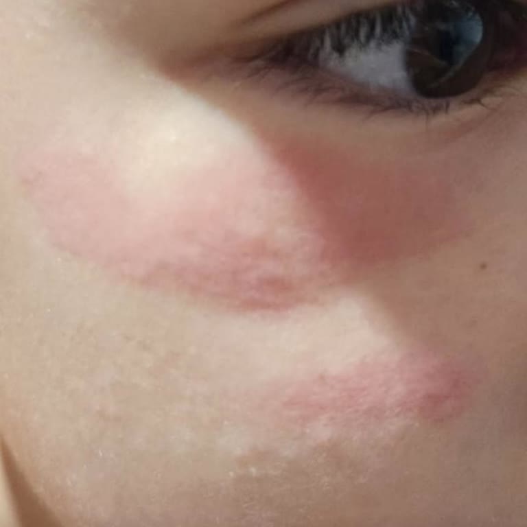 Hametan Krem Kullanımı Sonrası Cilt Reaksiyonu