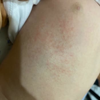Sma Optipro Çocuğumda Kabarcıklara Sebep Oldu