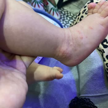 Bebek Mamalarında Beklenmedik Cilt Reaksiyonları