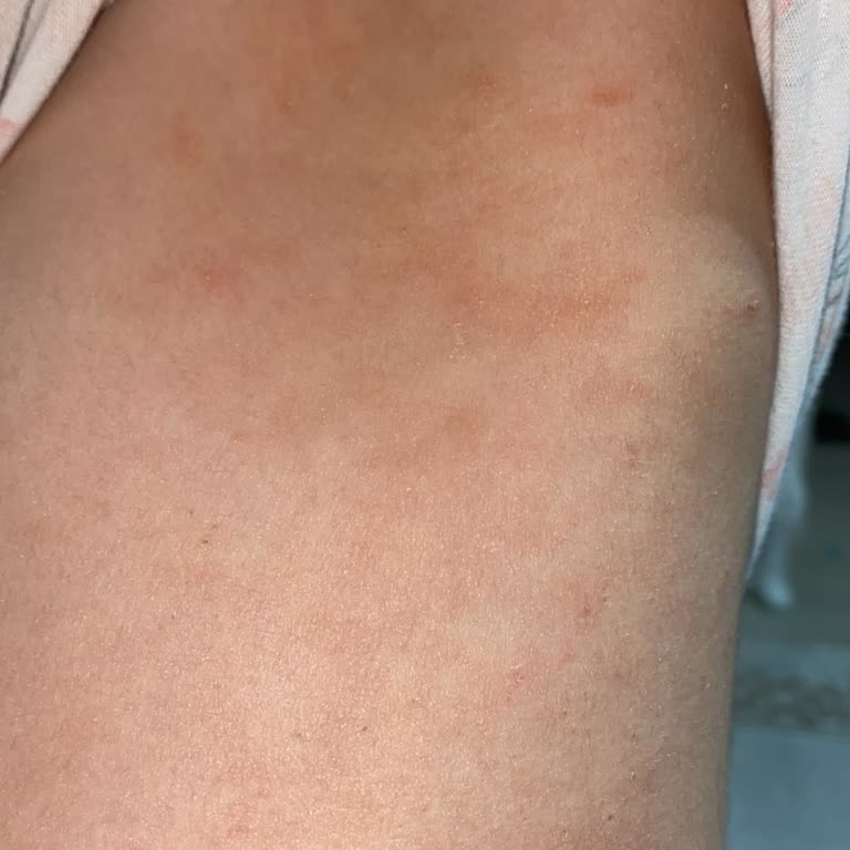 Yumoş Deterjanı Alerji Yaptı